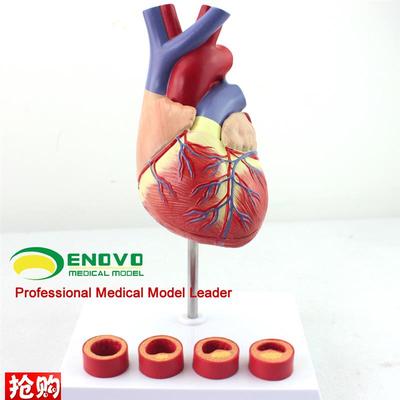 颐诺正品1:1医用人体心脏模型动E脉粥样硬化模型血栓心内科教学