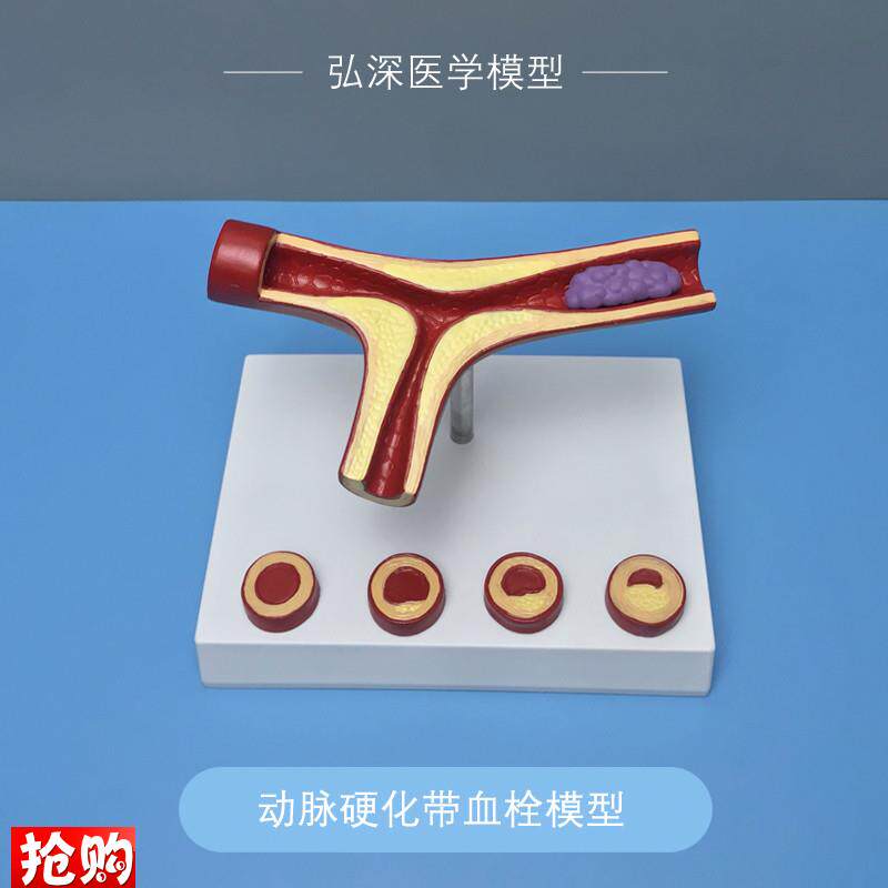 血管模型人体动脉硬化带血u栓粥样化病变过程展示教学心内医学讲