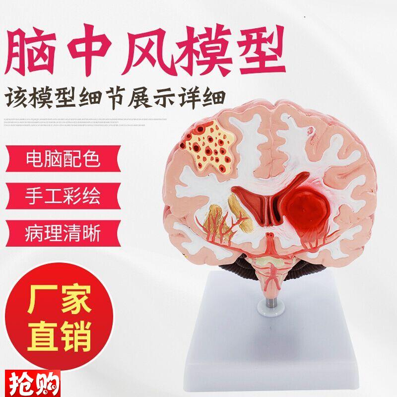 人体脑解剖脑病理疾病脑病理构造脑(血管U)病变脑模型