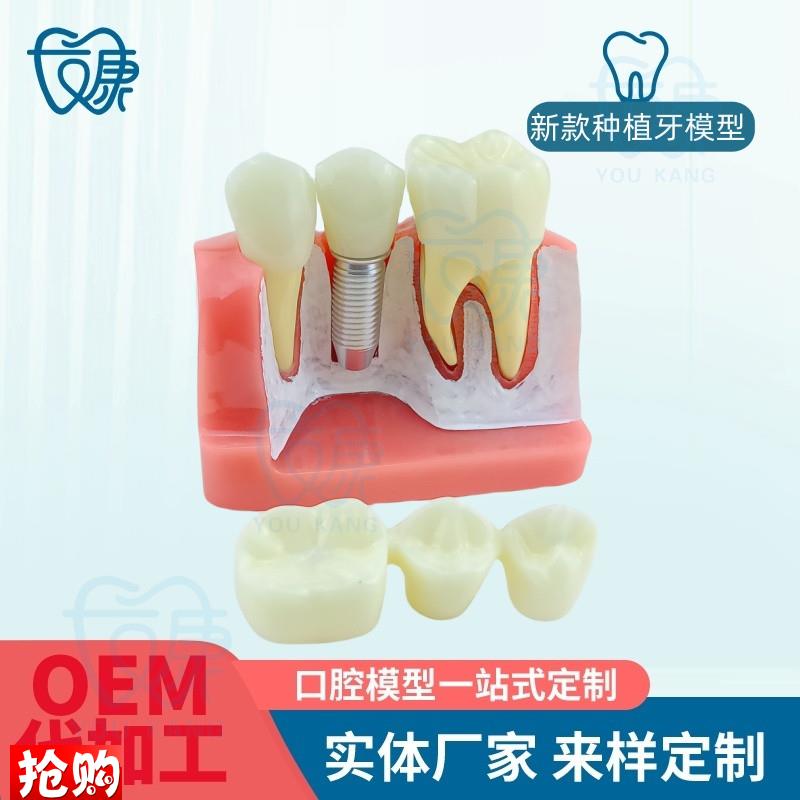 4倍种植牙模型种植体分析冠演示牙模型N种植体模型口腔教学模