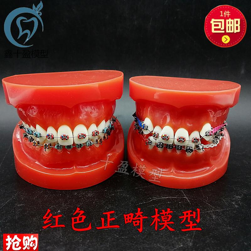 口腔牙列整齐正畸模型红牙列不齐错颌缺失牙齿仿真牵引.皮链支抗