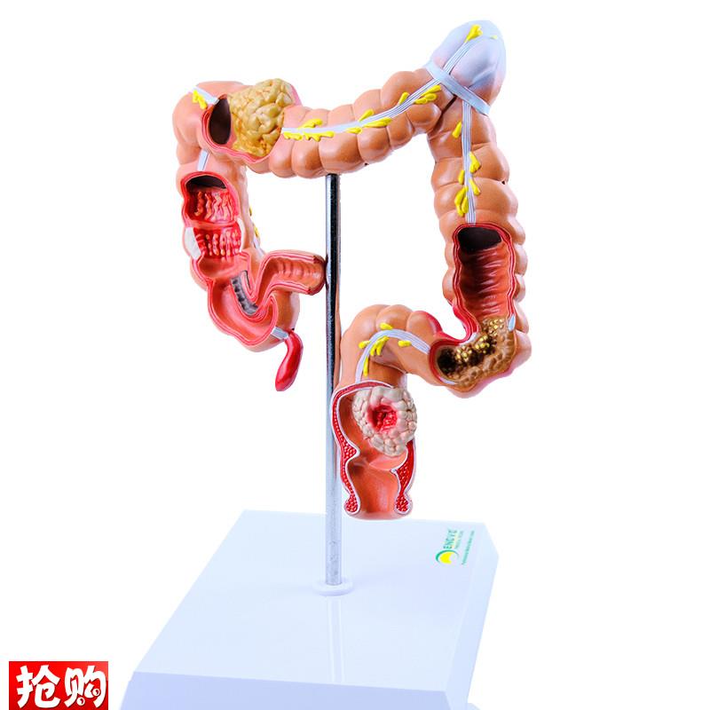 ENOVO颐诺人体大肠疾病展示模B型结肠直肠道病变症状消化系统疾病