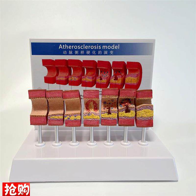 动脉血管模型e粥样病理硬化血管壁变细狭窄内膜斑块沉积阻塞程度