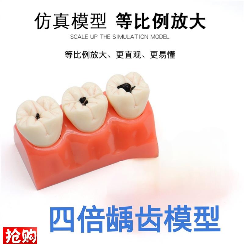 牙科医患沟e通病理牙模型窝沟封闭种植龋齿根管龋齿病理分解模型