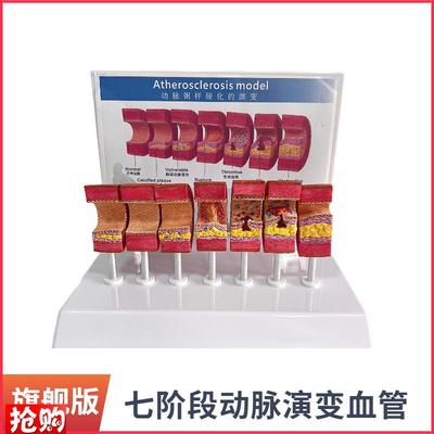 动脉粥样硬化模型血管血栓栓塞模型动脉I血管人体医用医学教学教