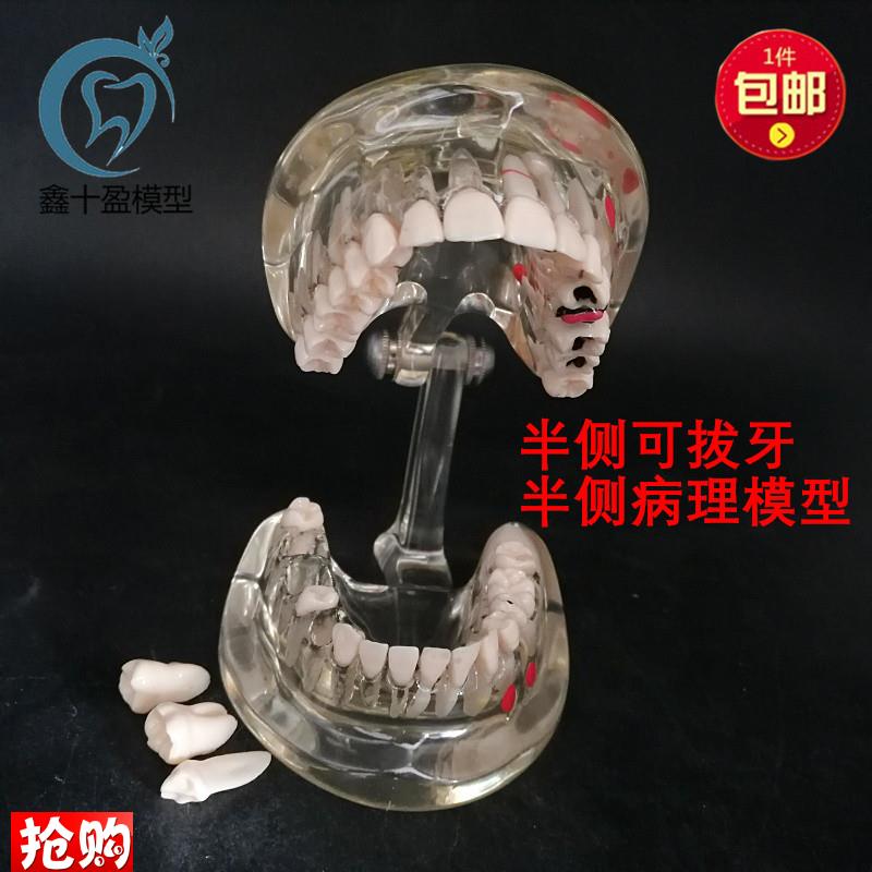 牙科牙齿b模型成人病理半侧可拔牙模型医患沟通口腔教学教具C3