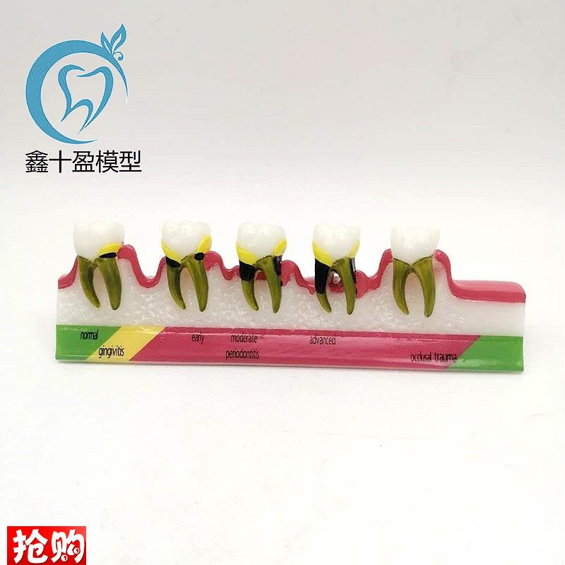 牙科口腔教学演示模型龋齿牙周根管医患沟通牙周分Z类模型M8