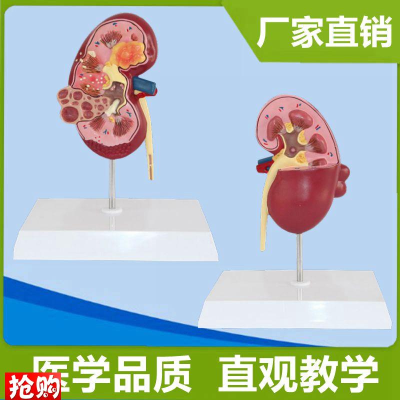 病理肾脏临床常见医患泌尿系统内脏医药礼品科普T展示健康宣传人