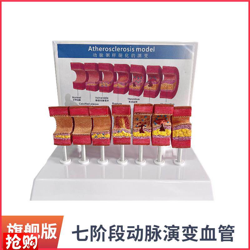 动脉粥样硬化模型血管血栓栓塞模型动脉血管人体医W用医学教学教