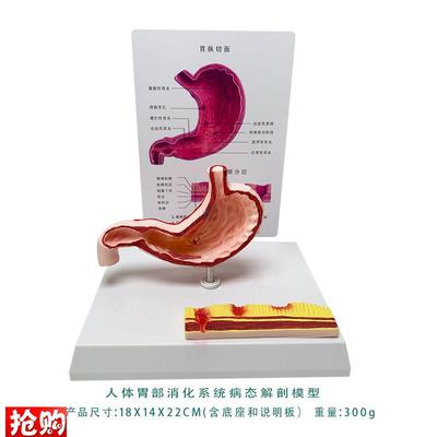 胃病态结构模型萎缩胃炎溃疡穿孔人体I消化系统模型人体解剖教具
