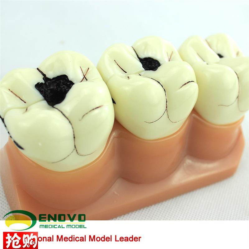 ENOVO正品口腔科牙齿龋齿分解模型口腔病理龋齿T模型医患沟通演示