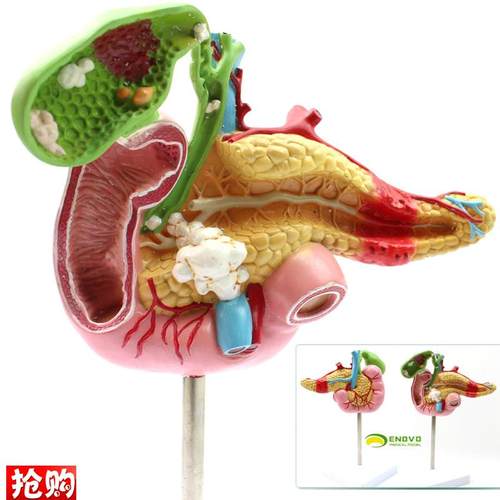 ENOVOd颐诺医学胰腺十二指肠胆囊病理模型外科消化科系统模具肝胆