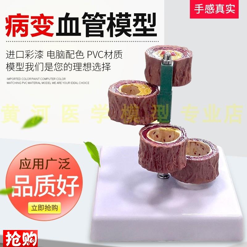 硬化支脉粥样血管m模型心血管动脉解剖模型人体病态血管模型血栓