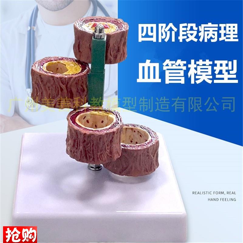 血管解剖模型动脉粥p样化病理心血管血液循环血栓教学模型