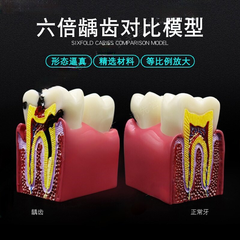 牙科口腔c模型 解剖放大蛀牙模具医患沟通六倍牙齿龋坏病理演示
