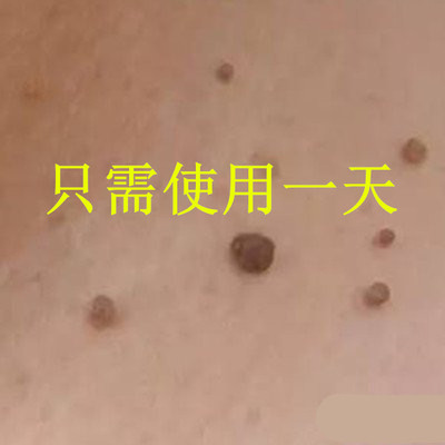 去除肉刺腋下脖子长小皮粒