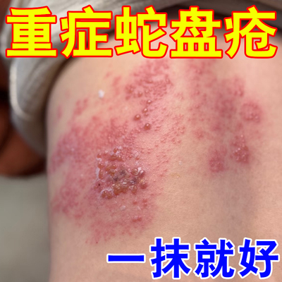 蛇盘疮专用膏药后遗症神经痛疼外用药带状疱泡疹蛇缠腰蛇胆疮克星
