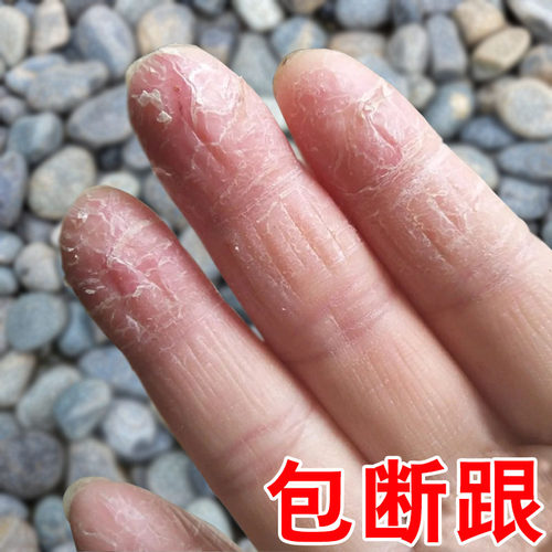 手脱皮严重脱皮专用药膏手指干裂蜕皮真菌干燥起皮皲裂感染护手霜