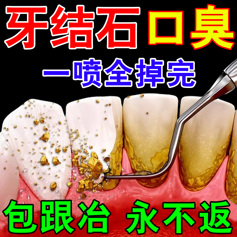 牙结石去除器溶解牙石速效清理喷雾牙渍牙垢口臭清除神器漱口水
