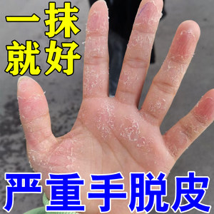 治疗手脱皮的药膏真菌感染成人儿童手指手掌手癣手足脚干裂蜕皮药