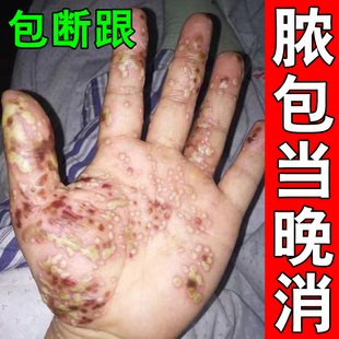 掌趾脓疱病专用药膏掌跖角化症手脚红斑干裂蜕皮角皮症掌跖脓包病