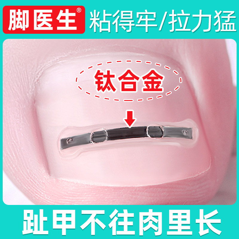 ⭐⭐脚医生甲沟嵌甲矫正器炎正甲贴脚趾甲贴指甲长肉里专用拉拉脚沟