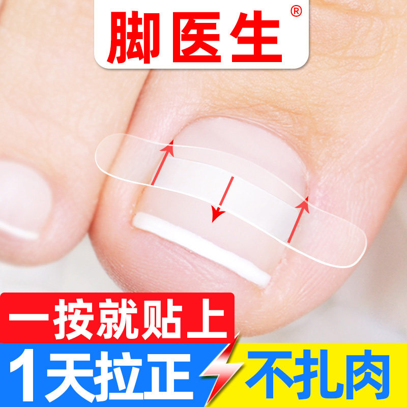脚医生甲沟嵌甲矫正器炎正甲贴脚趾甲贴片指甲长肉里专用拉拉脚沟