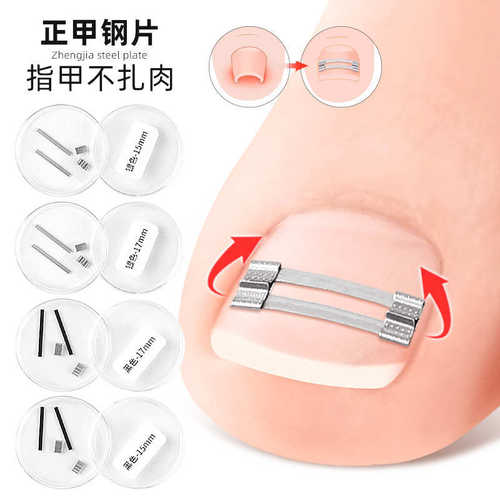正甲钢片拉伸贴物理辅助甲沟嵌甲