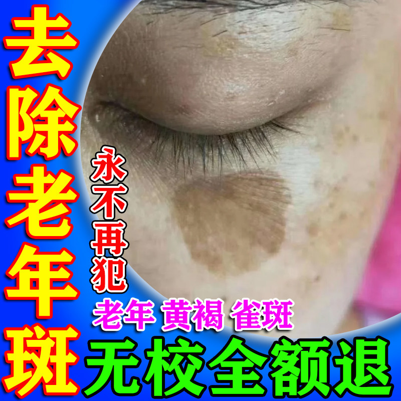 去老人斑专用药膏除老年黑班点斑霜黄褐斑强力祛除手部脸部的药膏