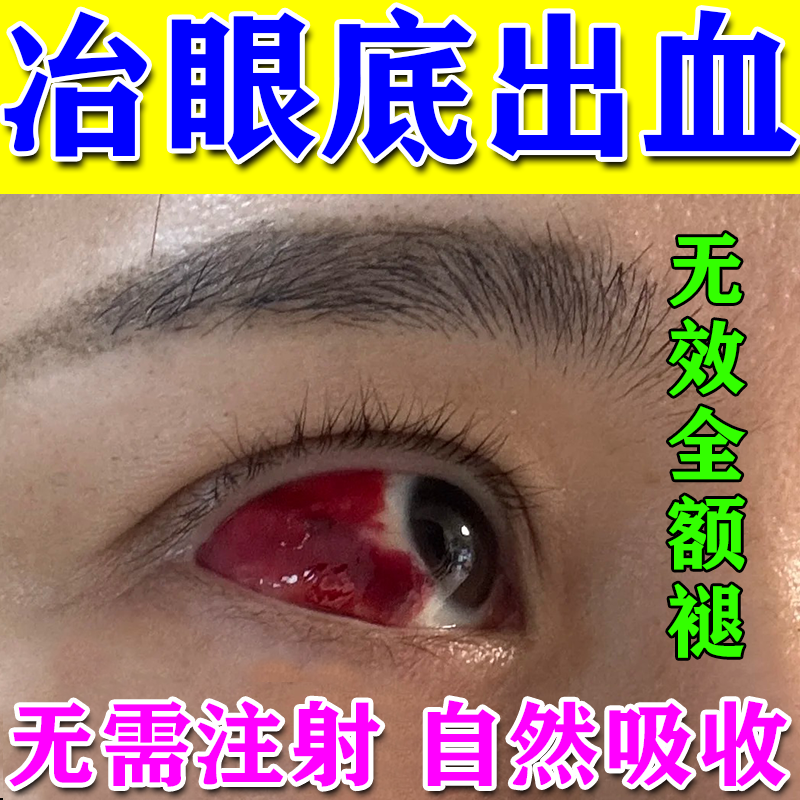 眼底出血眼药水眼部红血丝发红药