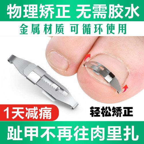 正甲扣甲沟矫正器正甲贴片脚趾甲嵌甲卷甲指甲长肉里修纠正神器炎 - 封面