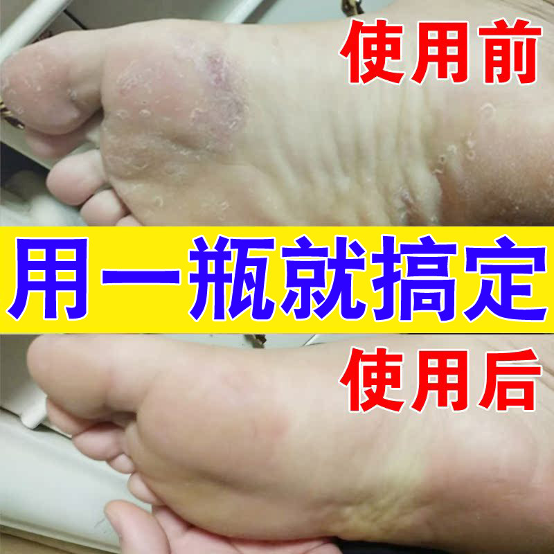 全净美脚气止痒脱皮杀菌特效去真菌感染喷雾烂脚丫偏方脚趾糜烂药