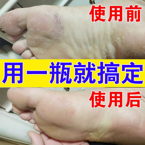 全净美脚气止痒脱皮杀菌特效去真菌感染喷雾烂脚丫偏方脚趾糜烂药