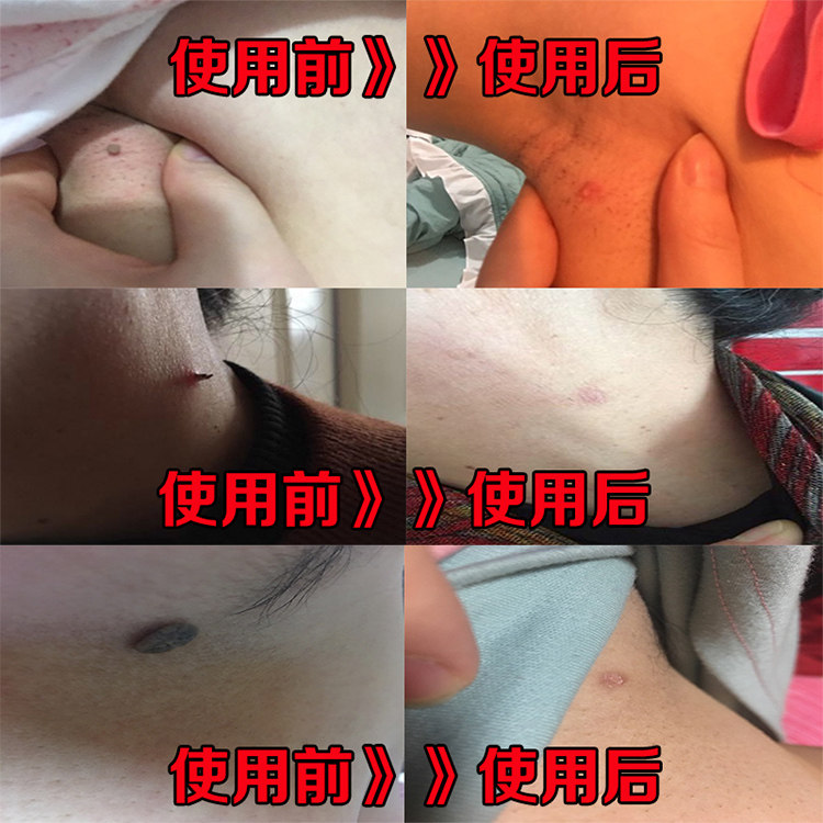 祛去除丝状尤膏脖子腋下颈部小肉粒猴子疙瘩肉赘皮赘肉瘤肉痣肉刺
