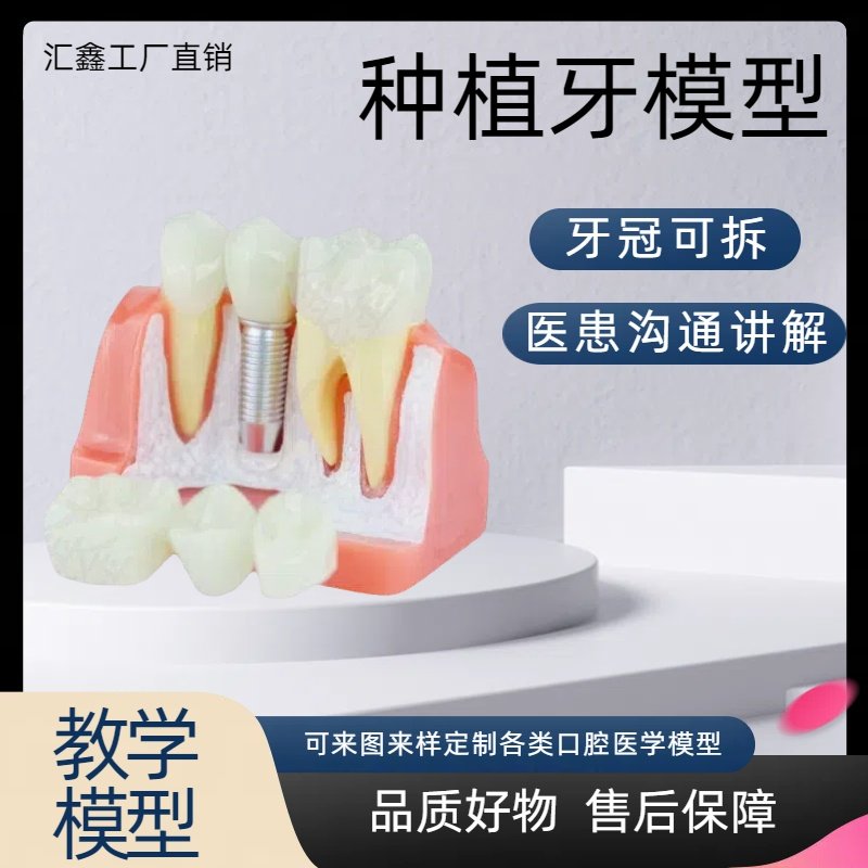 牙科种植模型口腔牙齿教学 牙科病理医患沟通模型 连桥牙冠种植钉