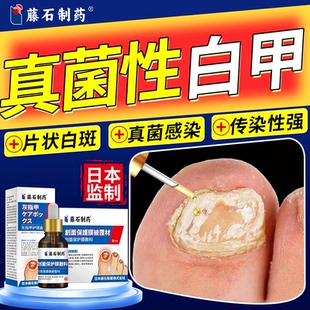 真菌性白甲手脚指甲发白有白斑点空甲床分离分层灰指甲真菌感染QK