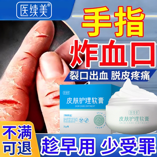 手指炸血口关节裂口子手癣脱皮干裂真菌感染药房同款手足裂口膏CA