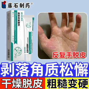 剥脱性角质松懈症松解手严重脱皮专用手指真菌感染蜕皮干燥起皮CA