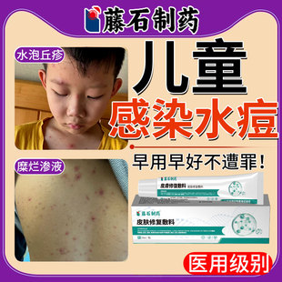 儿童水痘药房同售膏带状疱疹水泡专用水痘疤痕传染性外用止痒膏SK