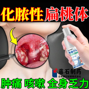 药房同售咽喉炎慢性咽炎除贴喉咙异物感扁桃体发炎根喷剂化脓性SK