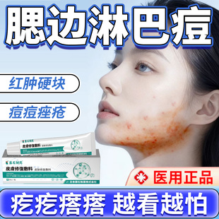 淋巴痘腮边痘下巴反复长痘专用痤疮膏红肿硬块痘痘药房同售调理VX