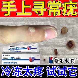 手上长寻常疣瘊子药房同售膏去除手指脱落根扁平疣医用小肉粒SK