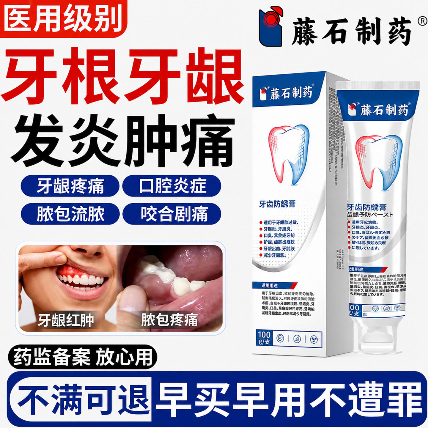 根尖周炎专用非牙膏牙龈脓包牙根尖炎急性牙周炎神器咬合肿痛SK