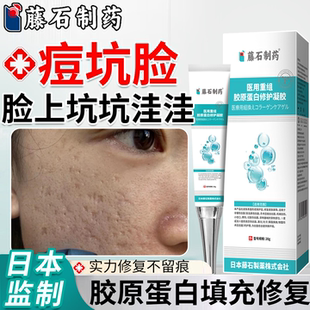 脸上坑坑洼洼修复肌肤痘坑凹洞修复生长因子改善毛孔祛痘印淡化VP