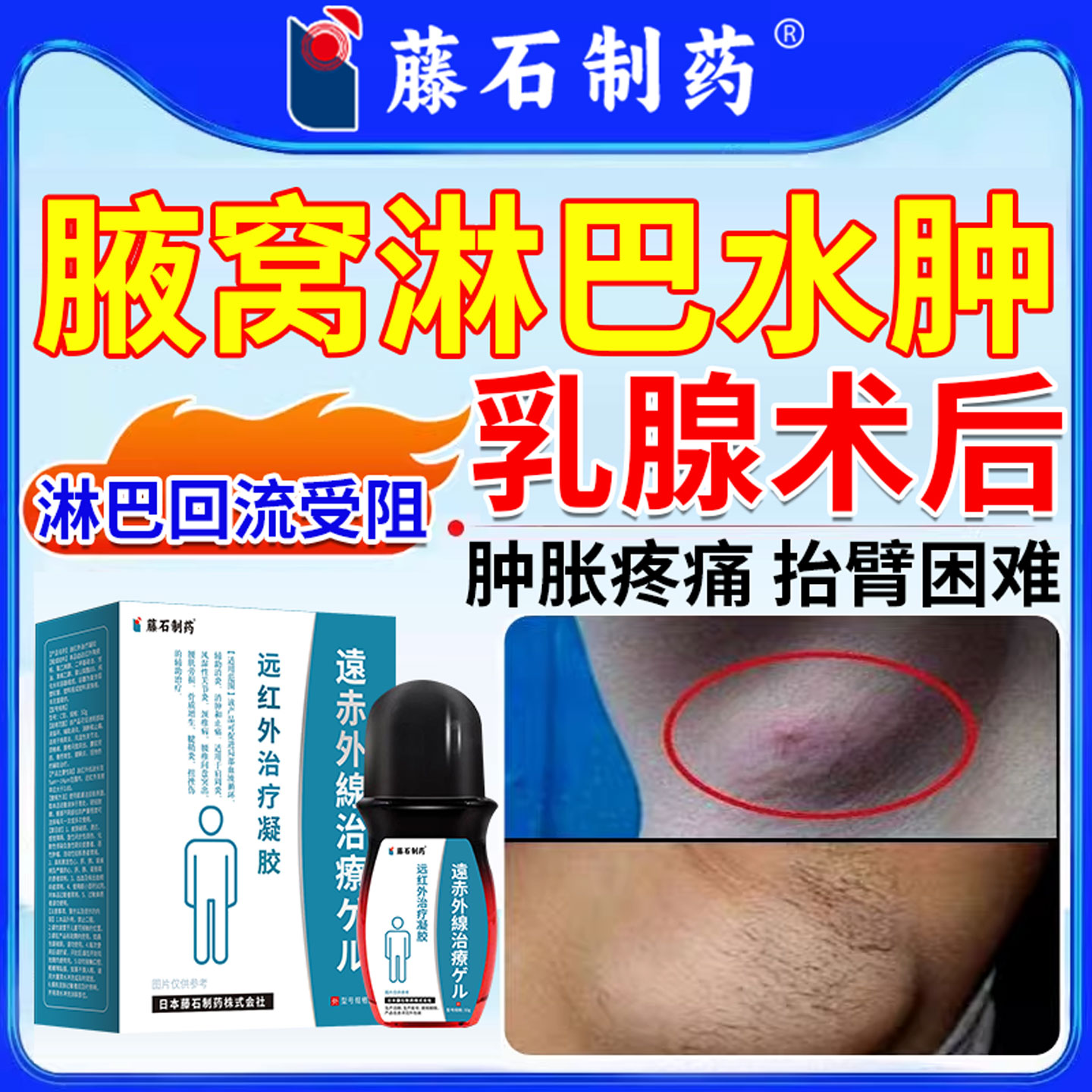 淋巴水肿乳腺术后腋窝胳膊上臂水肿淋巴水肿喷剂淋巴管堵塞受阻CA