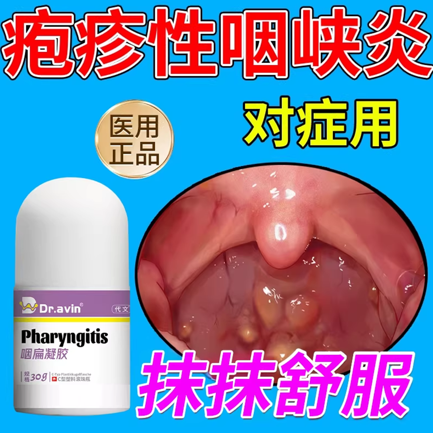 疱疹性咽峡炎喷雾儿童干扰素滤泡增生咽喉炎喷剂咽痛发热呕吐CA
