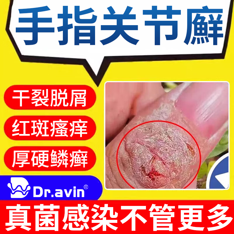 手指关节癣真菌感染可搭药膏脱皮干裂湿疹止痒去指节垫硬皮疙瘩vm