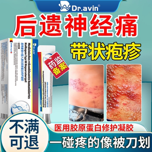 带状疱疹后遗神经痛特贴膏效专用断蛇盘疮根药房同售快速止痛CA