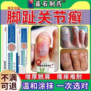 藤石制药脚趾头长关节癣鳞屑真菌感染足癣硬皮病黑干燥脱皮增厚CA