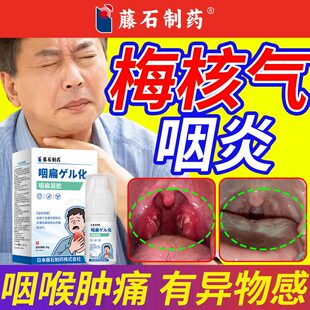 梅核气咽炎喉咙有异物感专用喷剂咳嗽老有痰多吐不完可搭膏贴SK